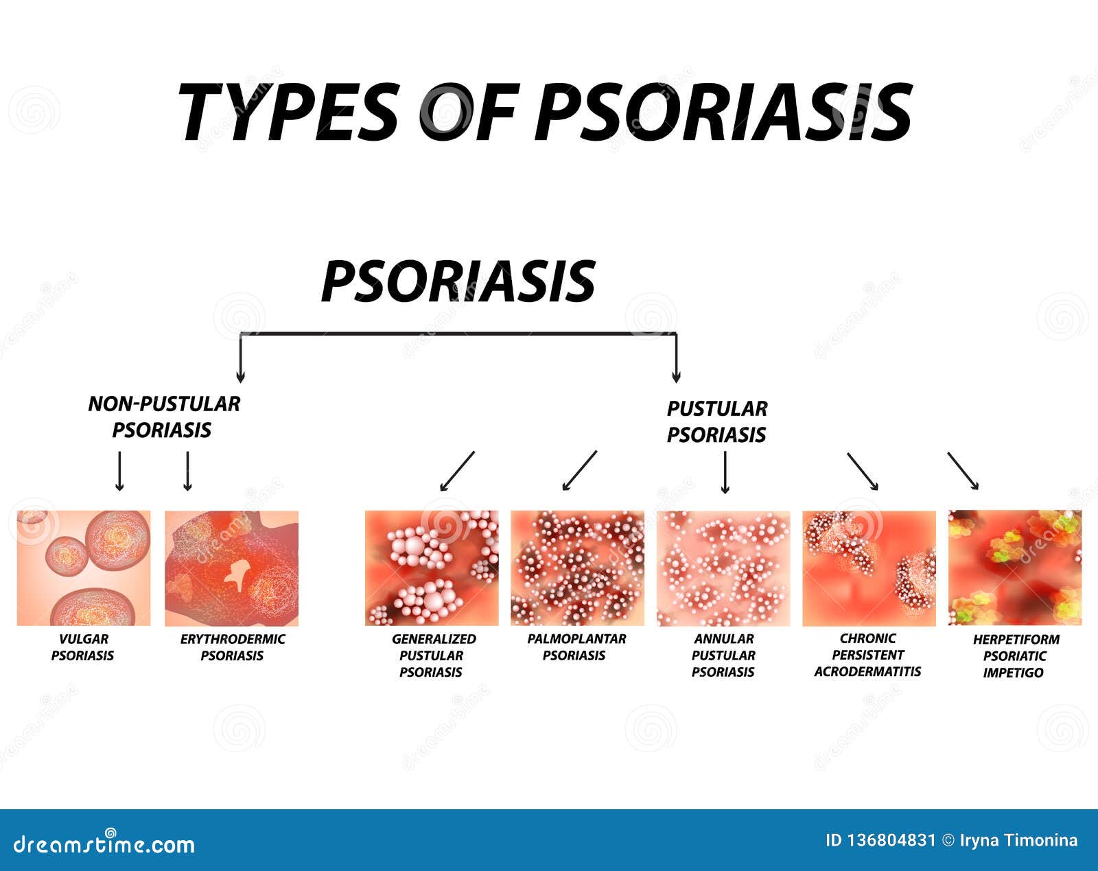 Psoriasis