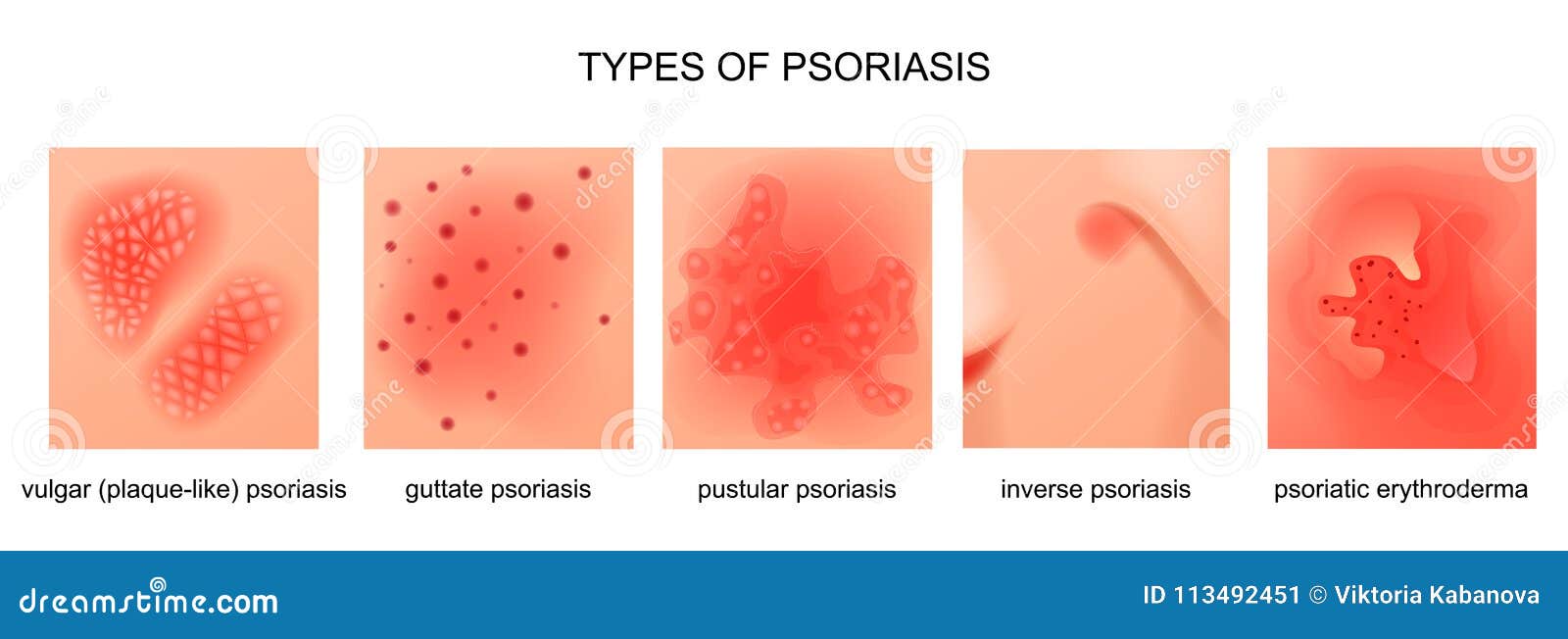 Psoriasis Cartoons, Illustrations & Vector Stock Images - 1786 Pictures