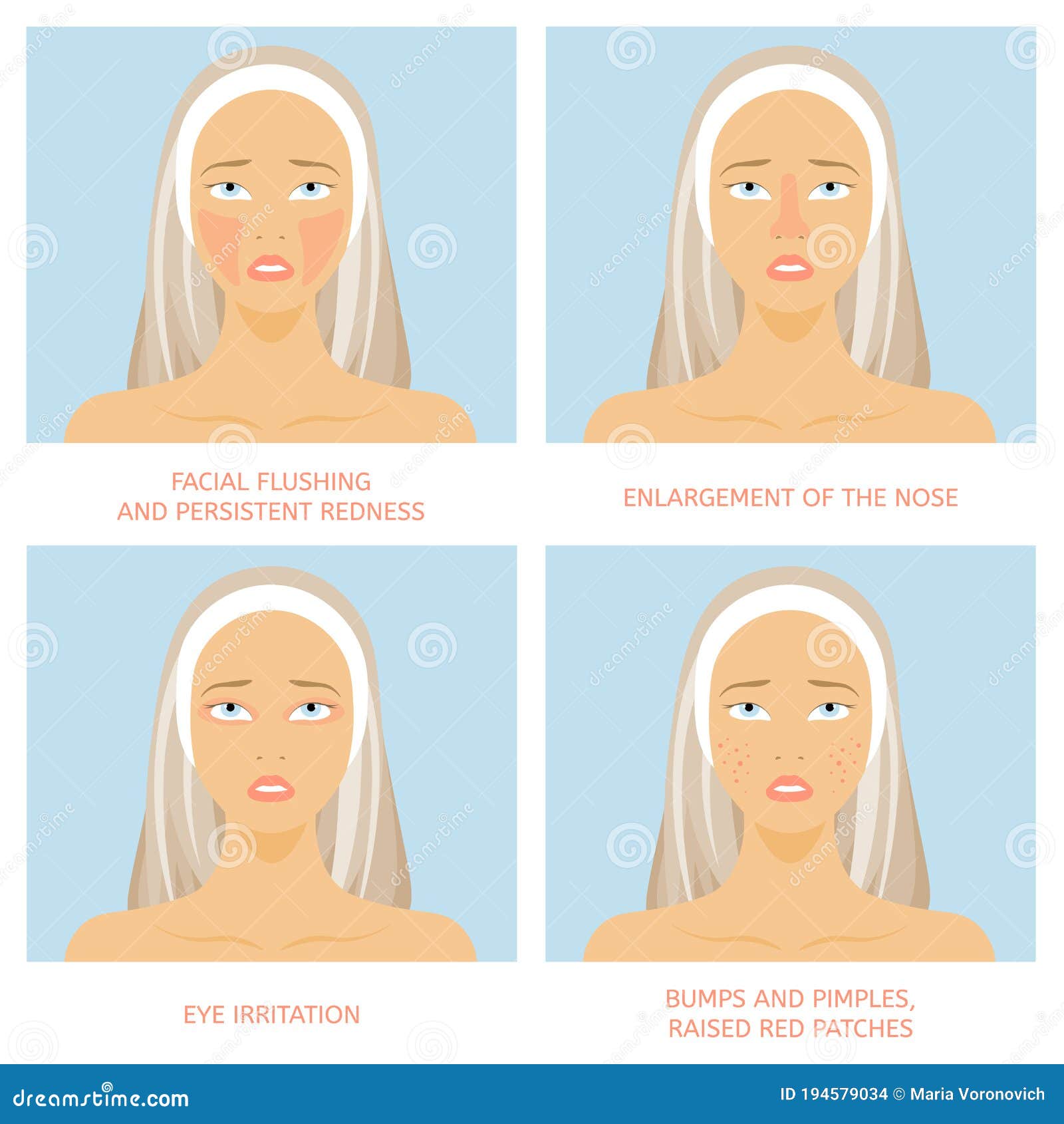 Types of Rosacea. Four Subtypes and Their Characteristics Stock Vector