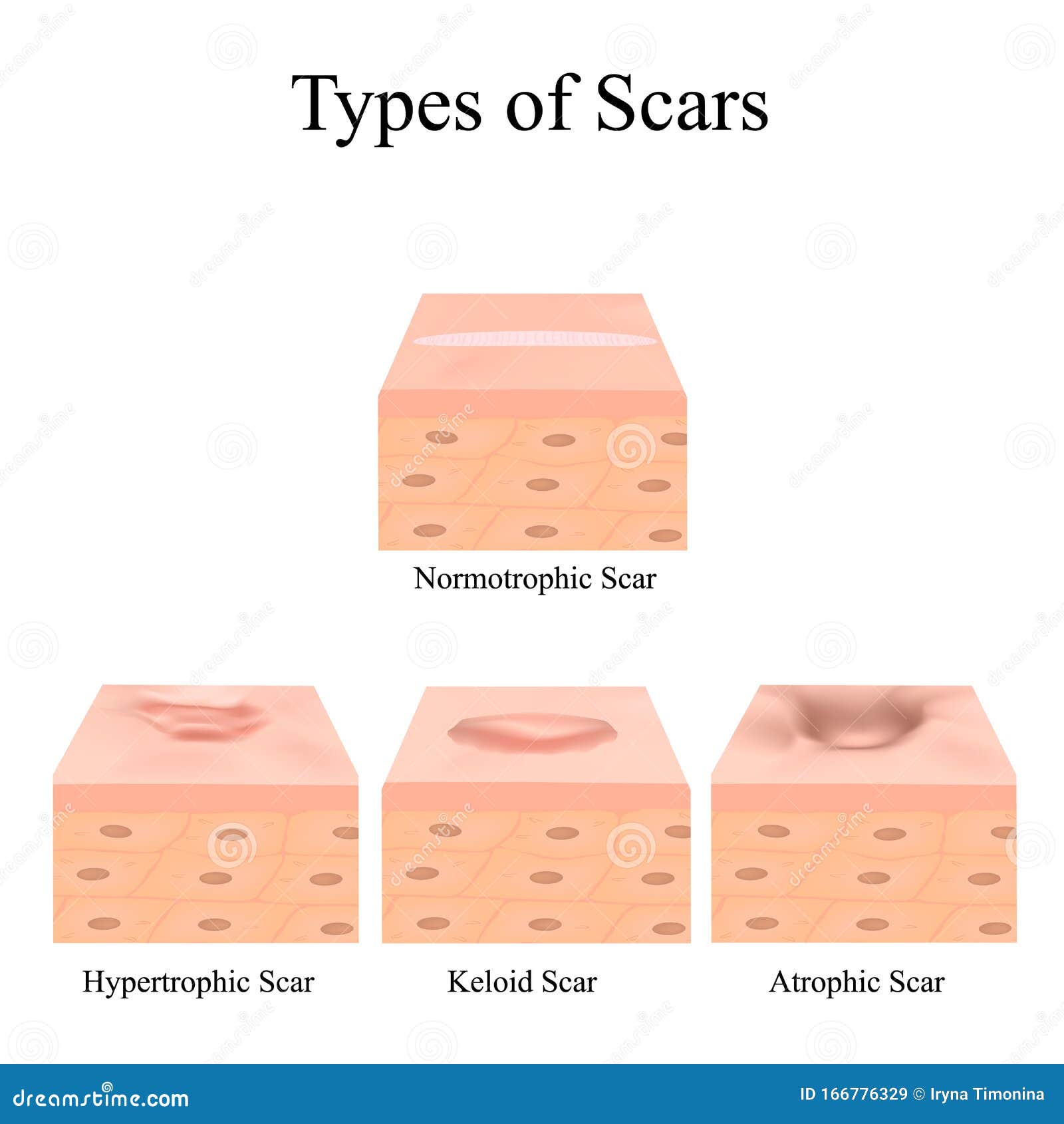 types of scars. acne scars. keloid, hypertrophic, atrophic, normotrophic. the anatomical structure of the skin with acne