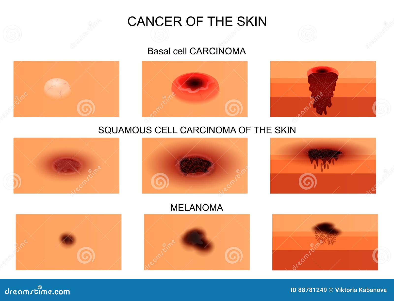 Examples Of Skin Cancer Types