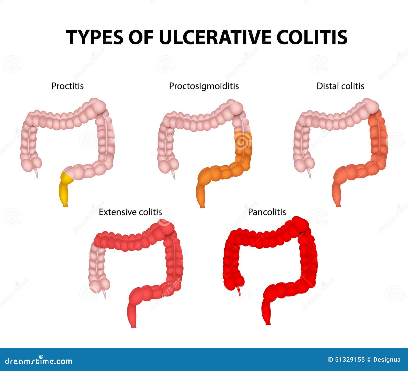 types of ulcerative colitis