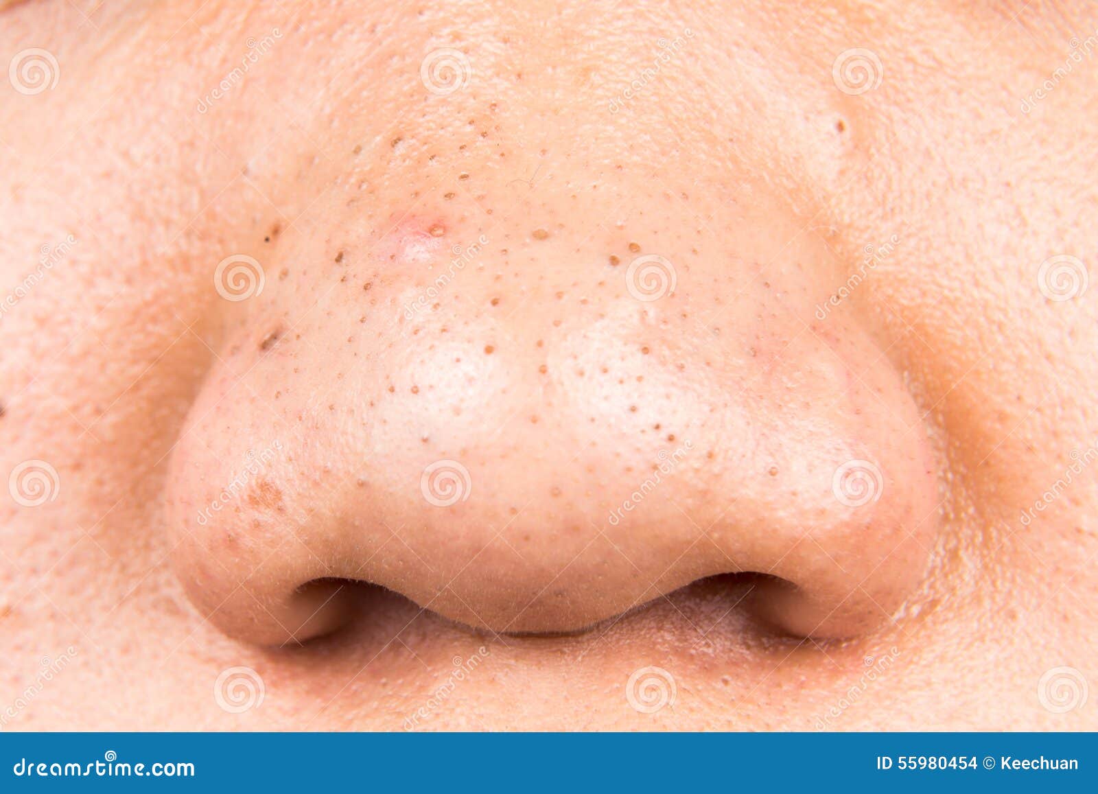 ugly pimples, acne, zit and blackheads on the nose of a teenager