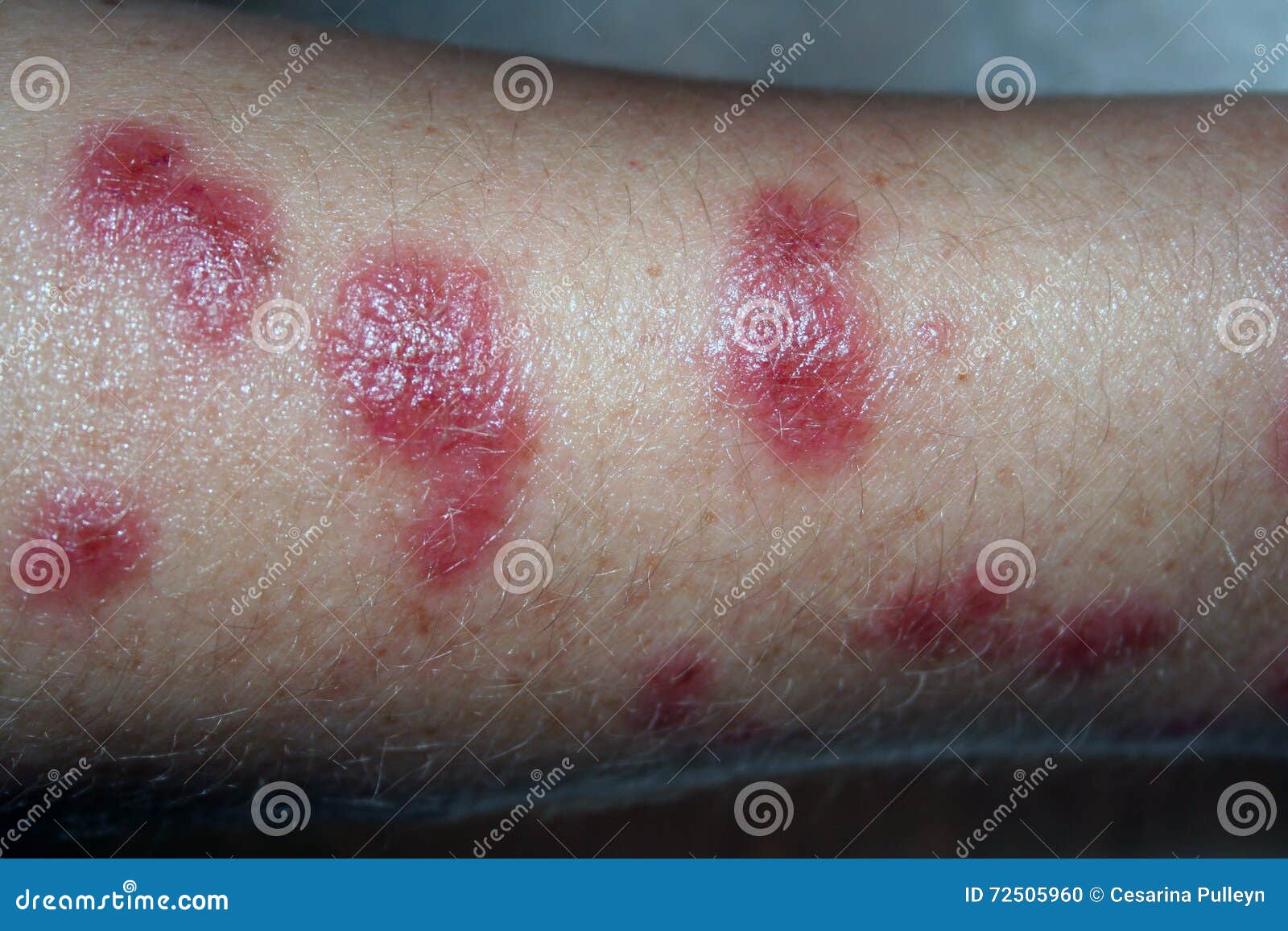 Ugly Skin Rash Royalty Free Stock Photography 72505547