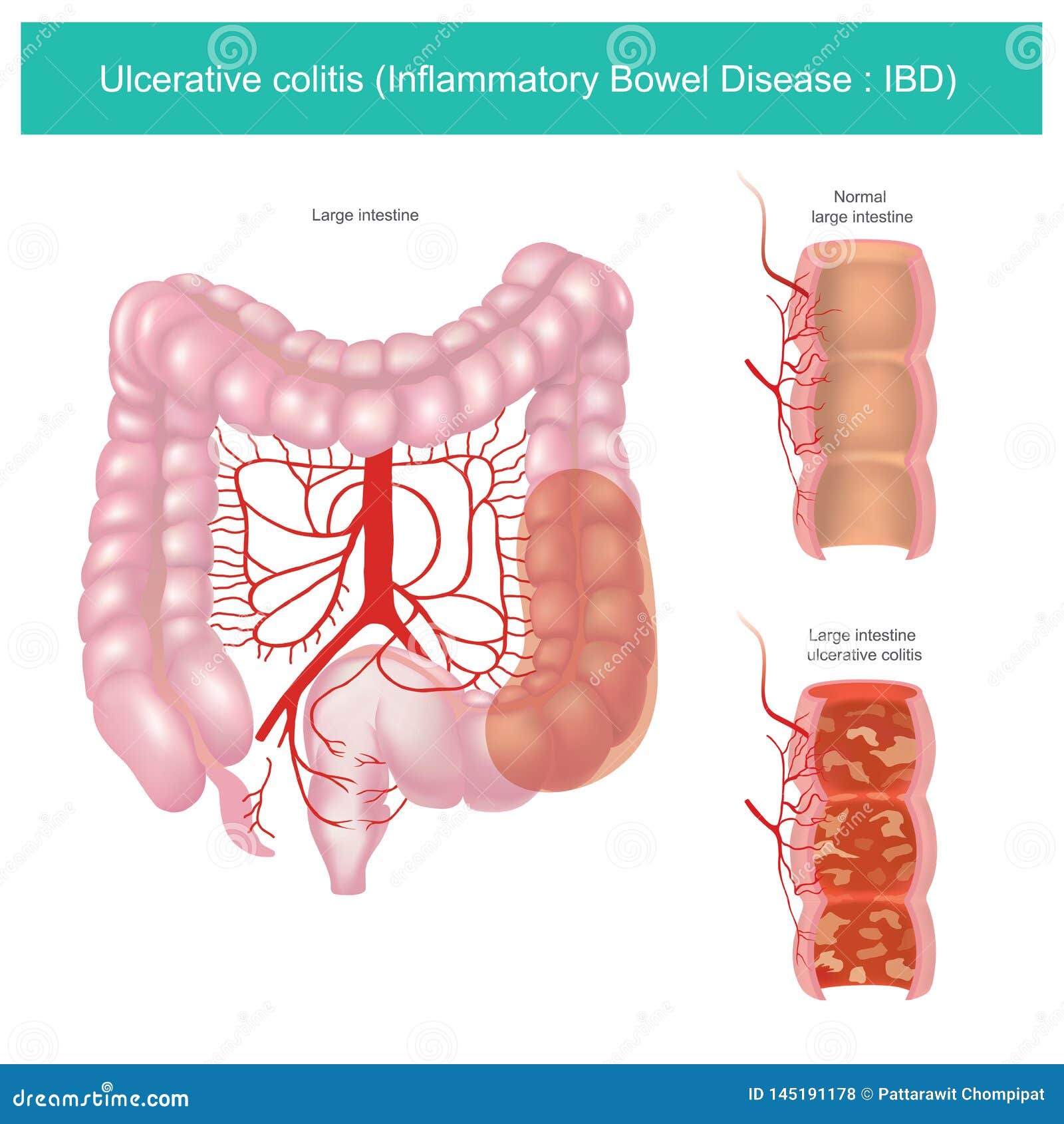ulcerative colitis.  graphic.