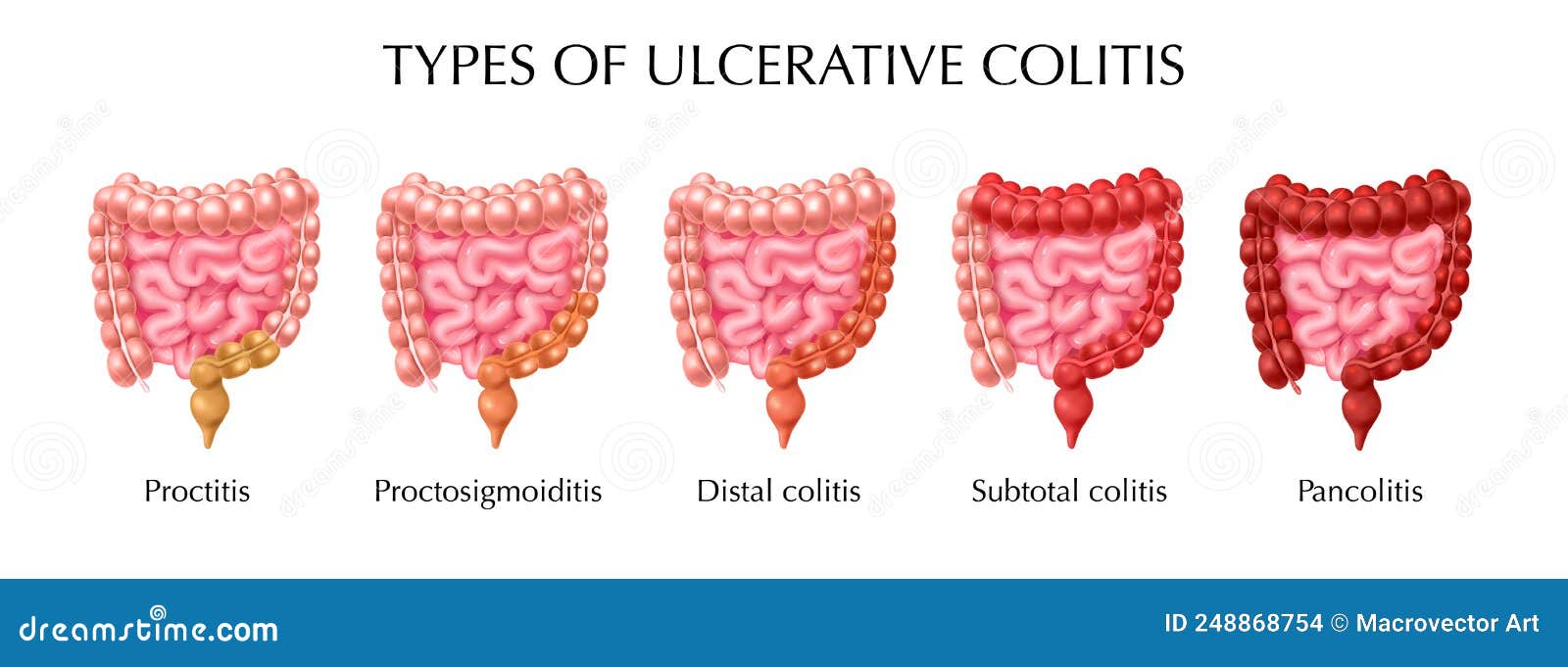 ulcerative colitis types infographics