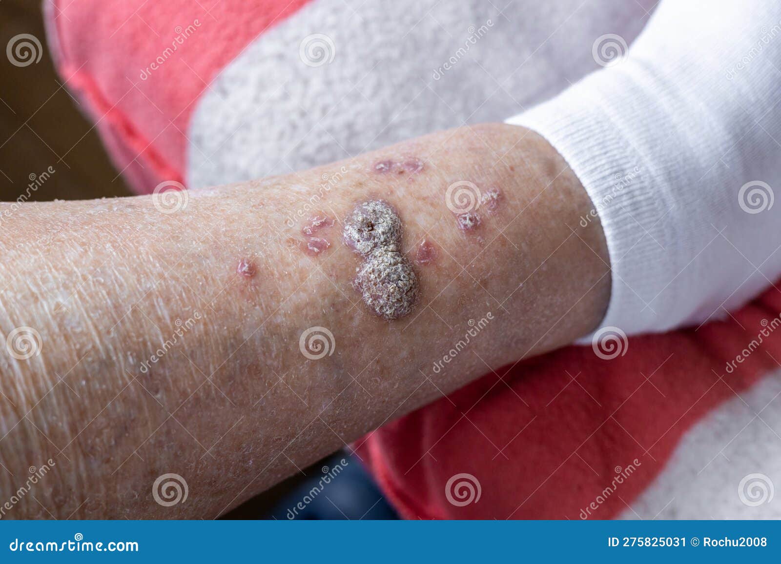 ulcers and skin diseases, dried scabs and fresh wounds on the legs of an elderly woman, health concept, senile changes