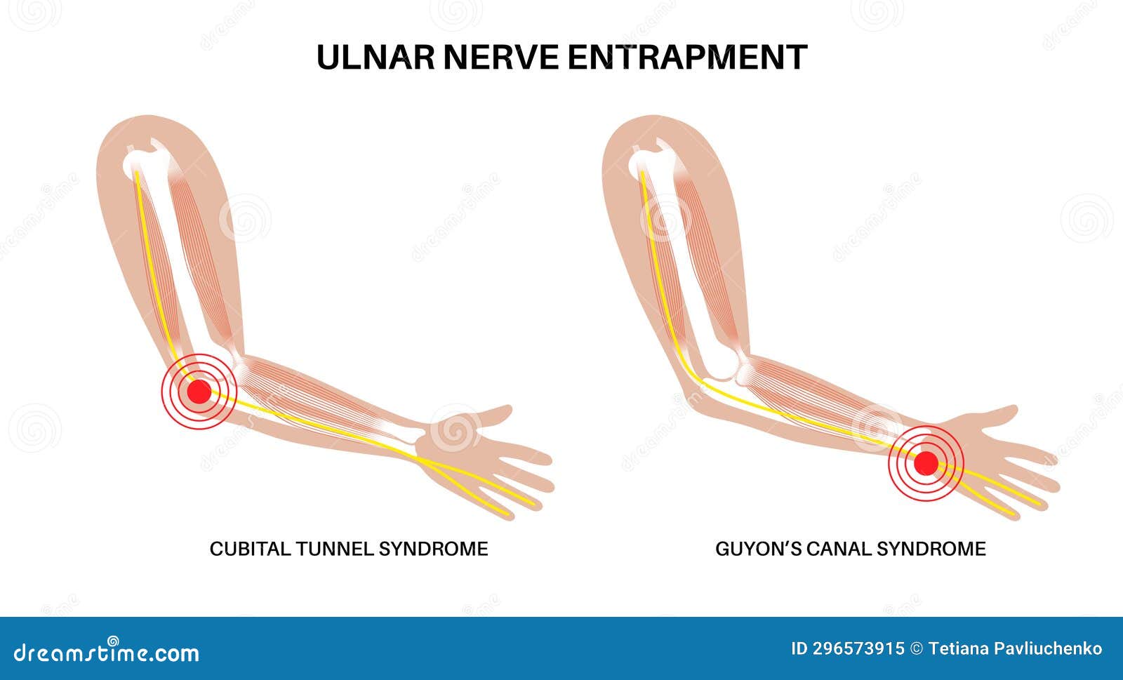 ulnar nerve entrapment