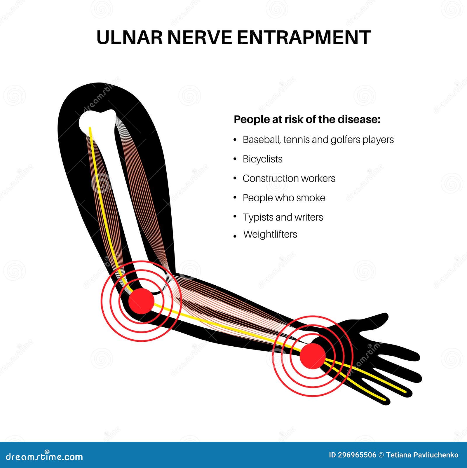 ulnar nerve entrapment