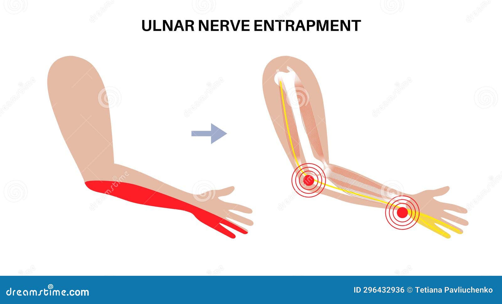 ulnar nerve entrapment