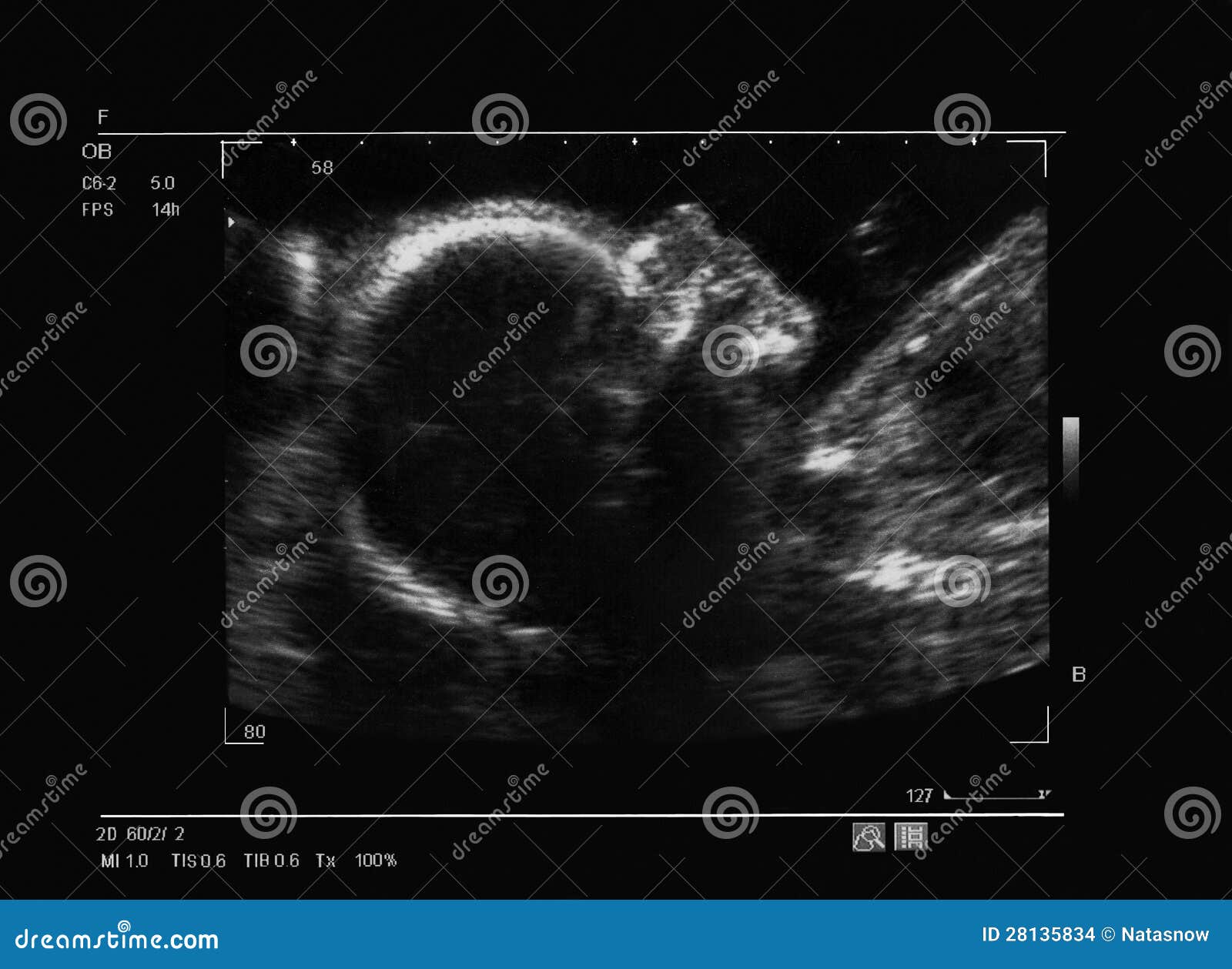Ultrasound of a Fetus at 26 Stock Photo - Image of uterus, ultrasound: 28135834
