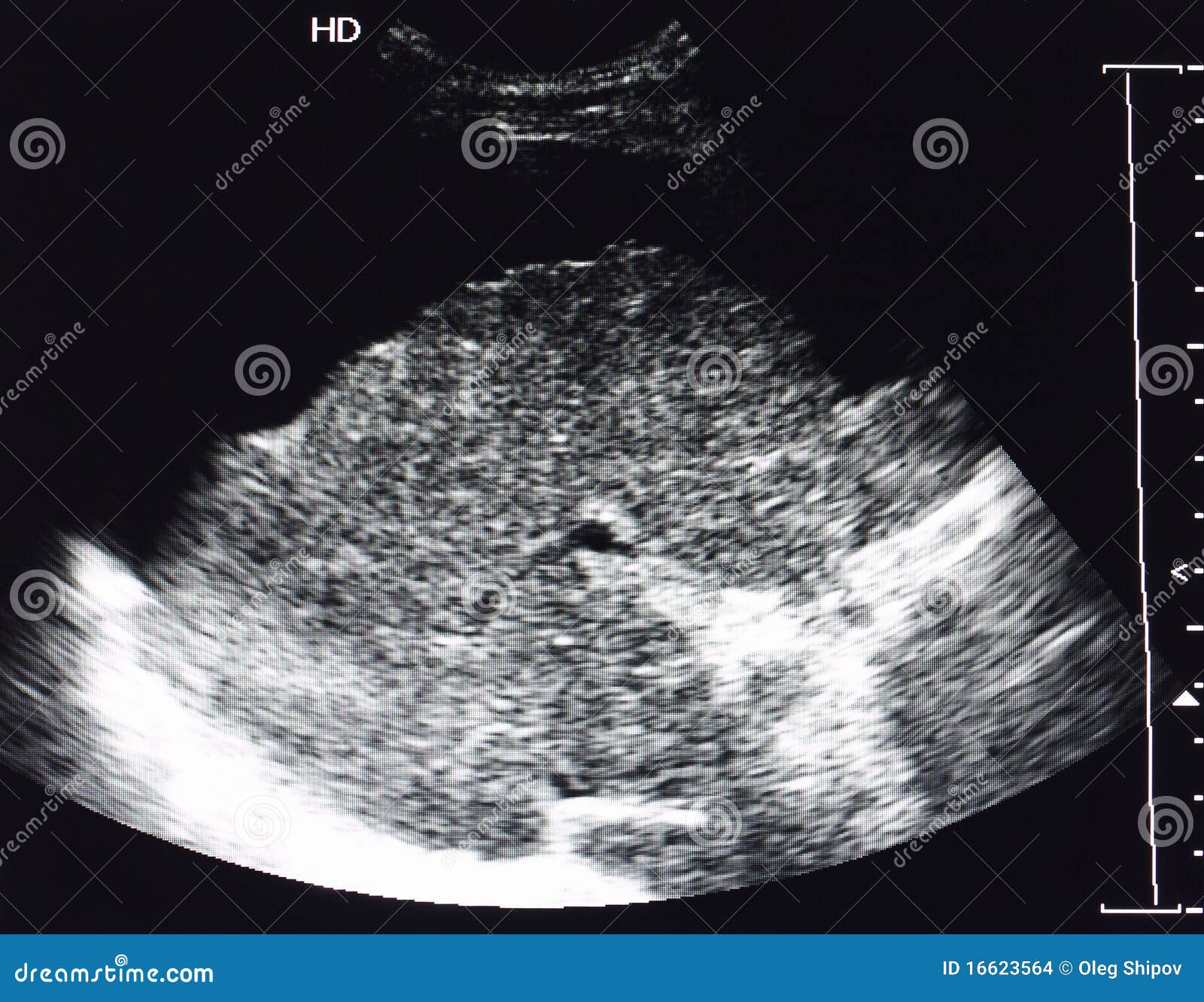 ultrasound image of liver cirrhosis