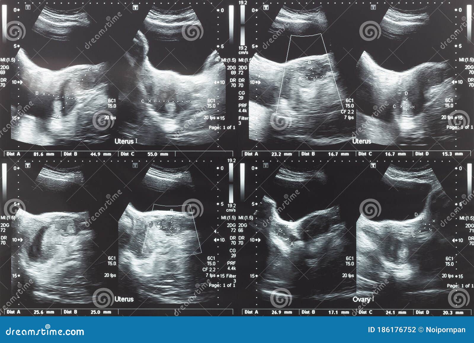 X ray Image Of Abdomen Supine Position Show Gastric Juice x-ray-image-of-abdomen-supine-position-show-gastric-juice