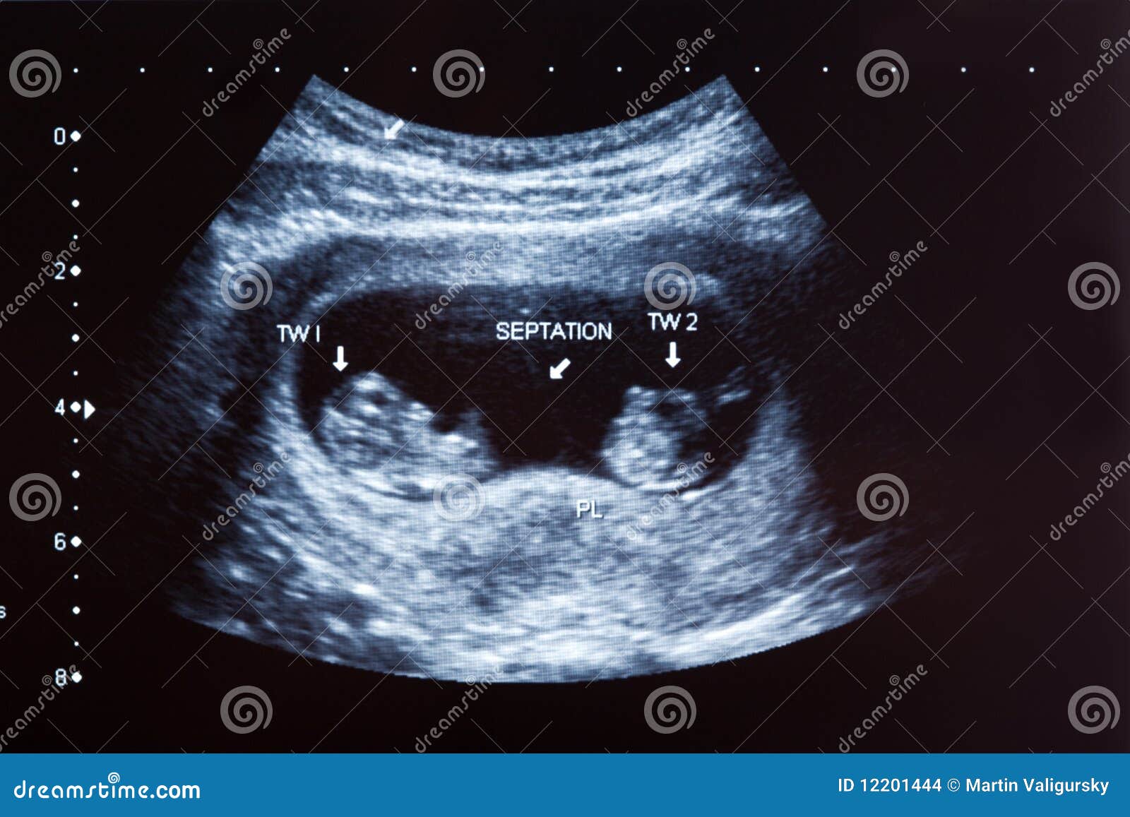 Ultrasound Scan Of 10 Weeks Old Twins Stock Photo - Image ...