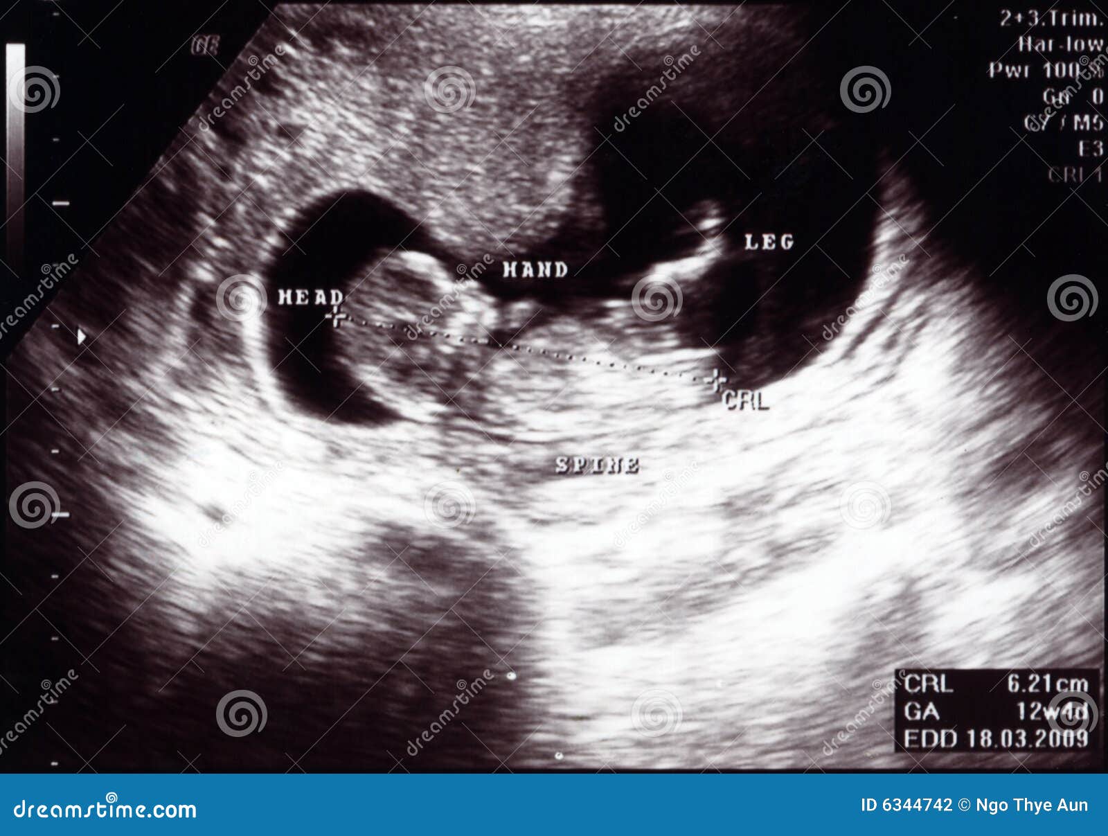 ultrasound scan 12 weeks