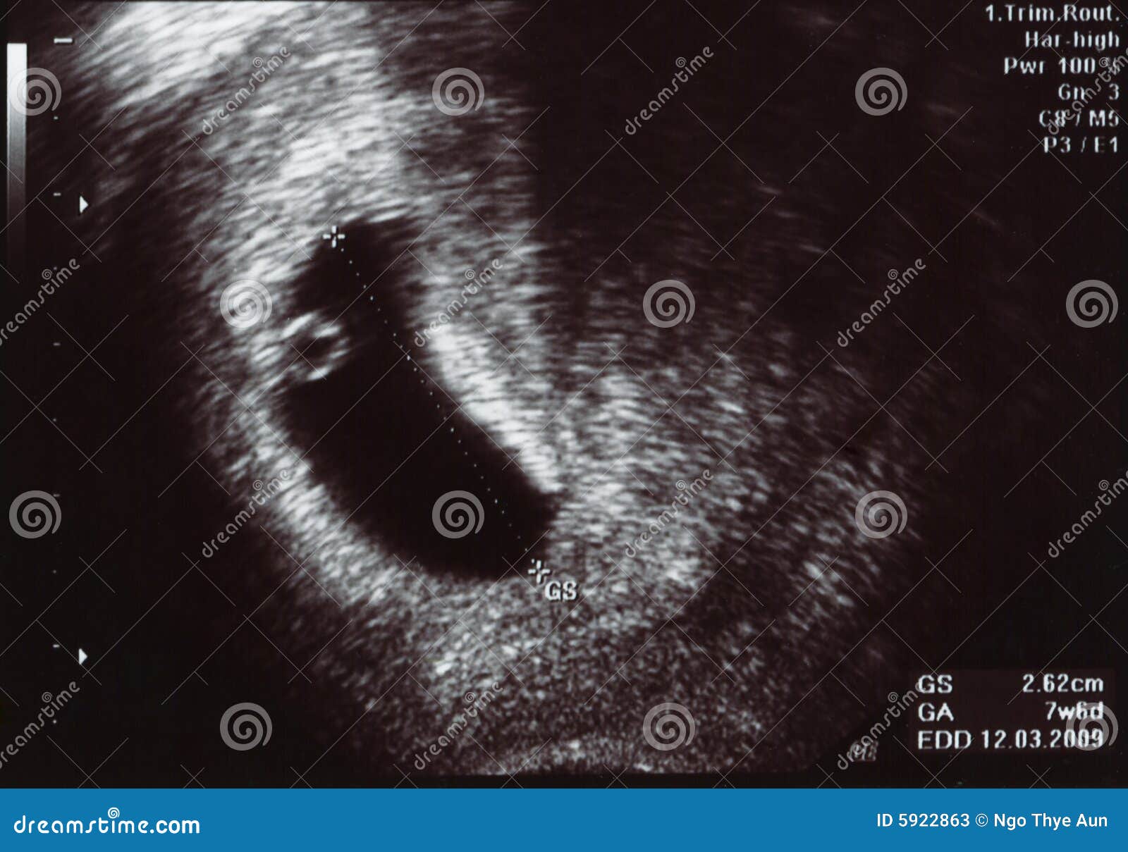 ultrasound scan one month