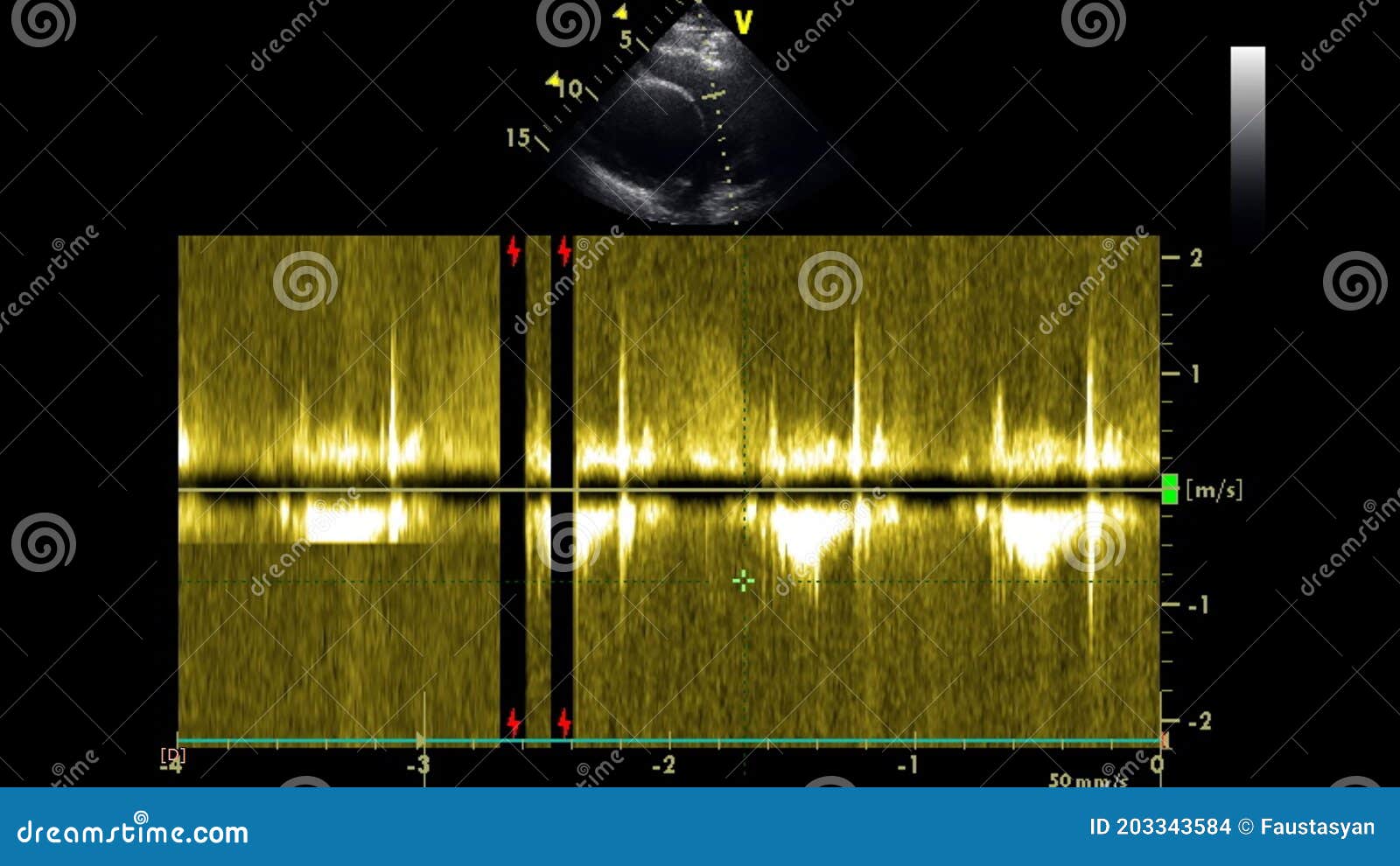 Ultrasound Transesophageal Examination of the Heart. Stock Photo