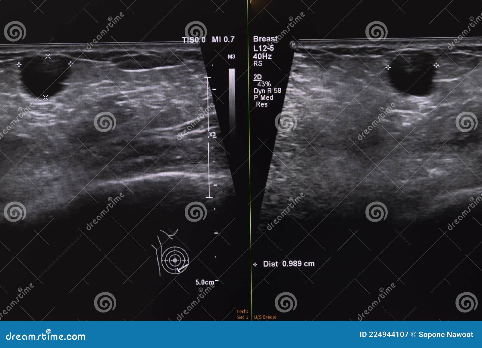 ultrasonography of breast nodule.