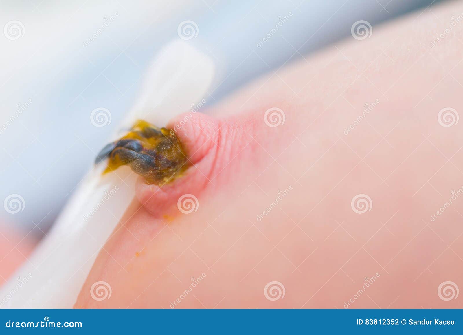 Umbilical Cord Falling Down Process Stock Photo Image of cord, home