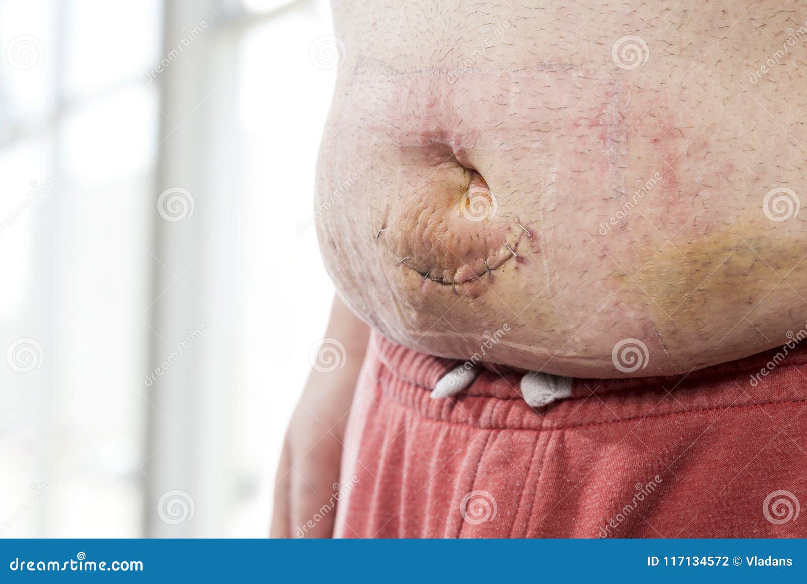 Umbilical Hernia Incision Stock Photo Image Of Painful 117134572