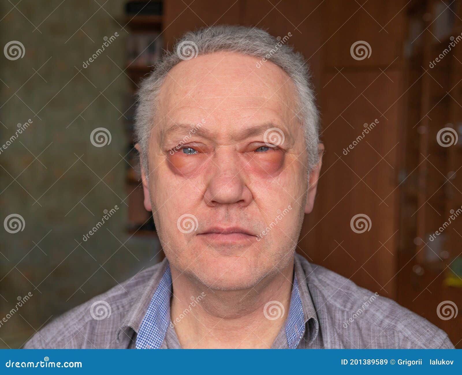 Un Hombre Con Los Ojos Hinchados. La Alergia a Los Medicamentos Imagen