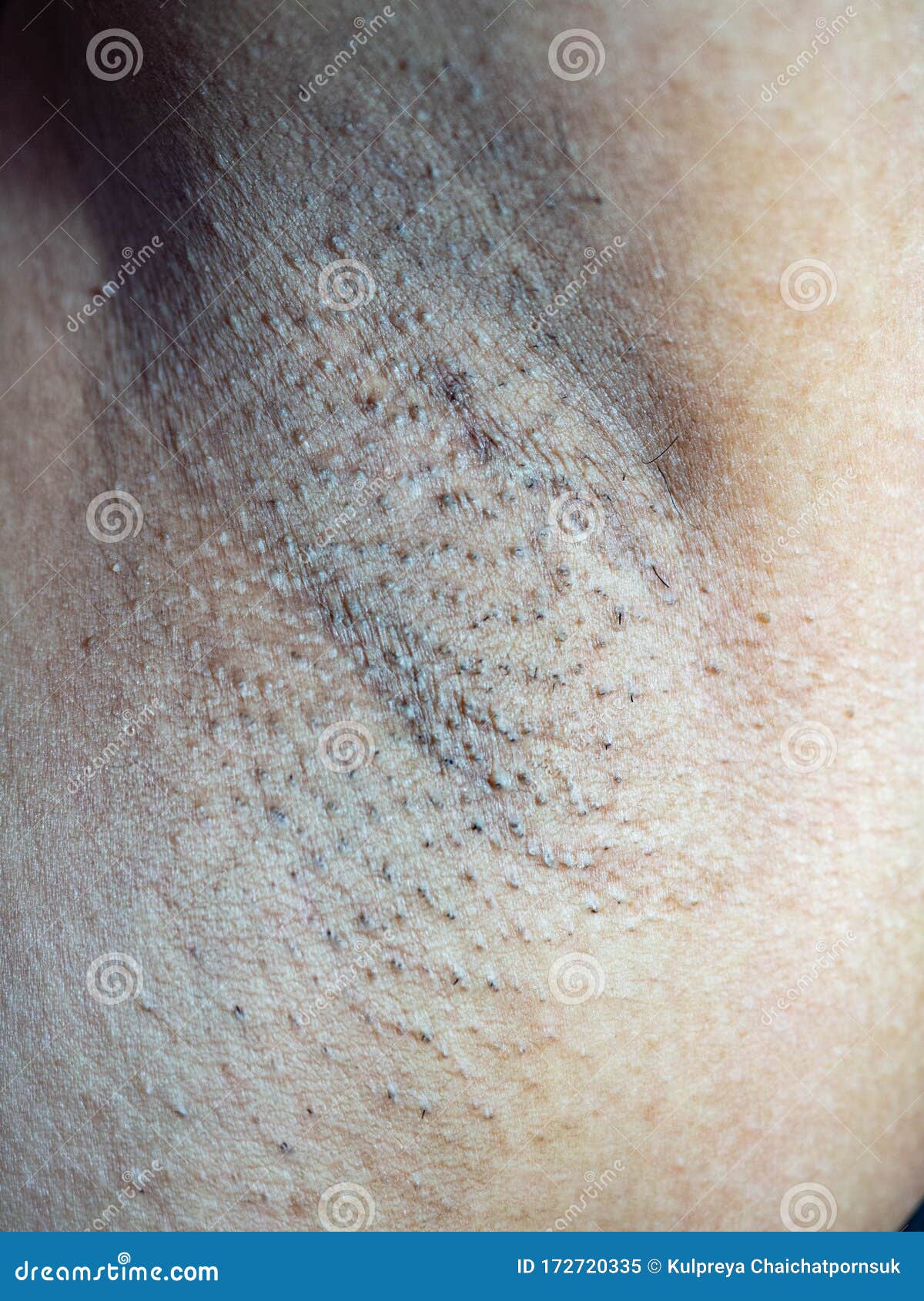 Underarm Black Patches,the Skin is Not Smooth,Has Short Hairs. Stock Image  - Image of hairs, pattern: 172720335