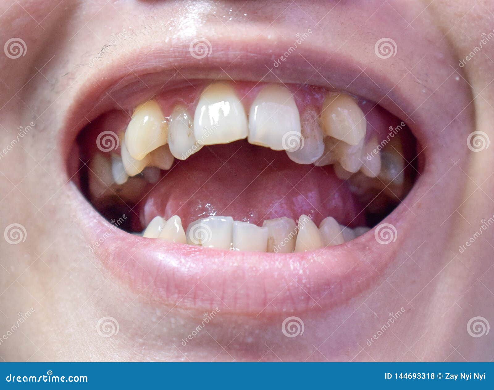 malocclusion, overcrowding of both upper and lower teeth