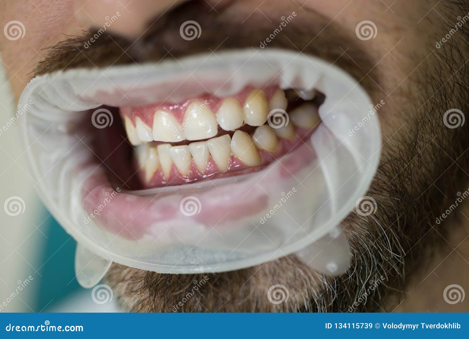 Ung man som väljer färg av tänder på den tandläkareFemale tandläkaren som kontrollerar tålmodiga tänder med spegeln i modern tand- klinik Stående av den gladlynta manliga personen med vita tänder för snö