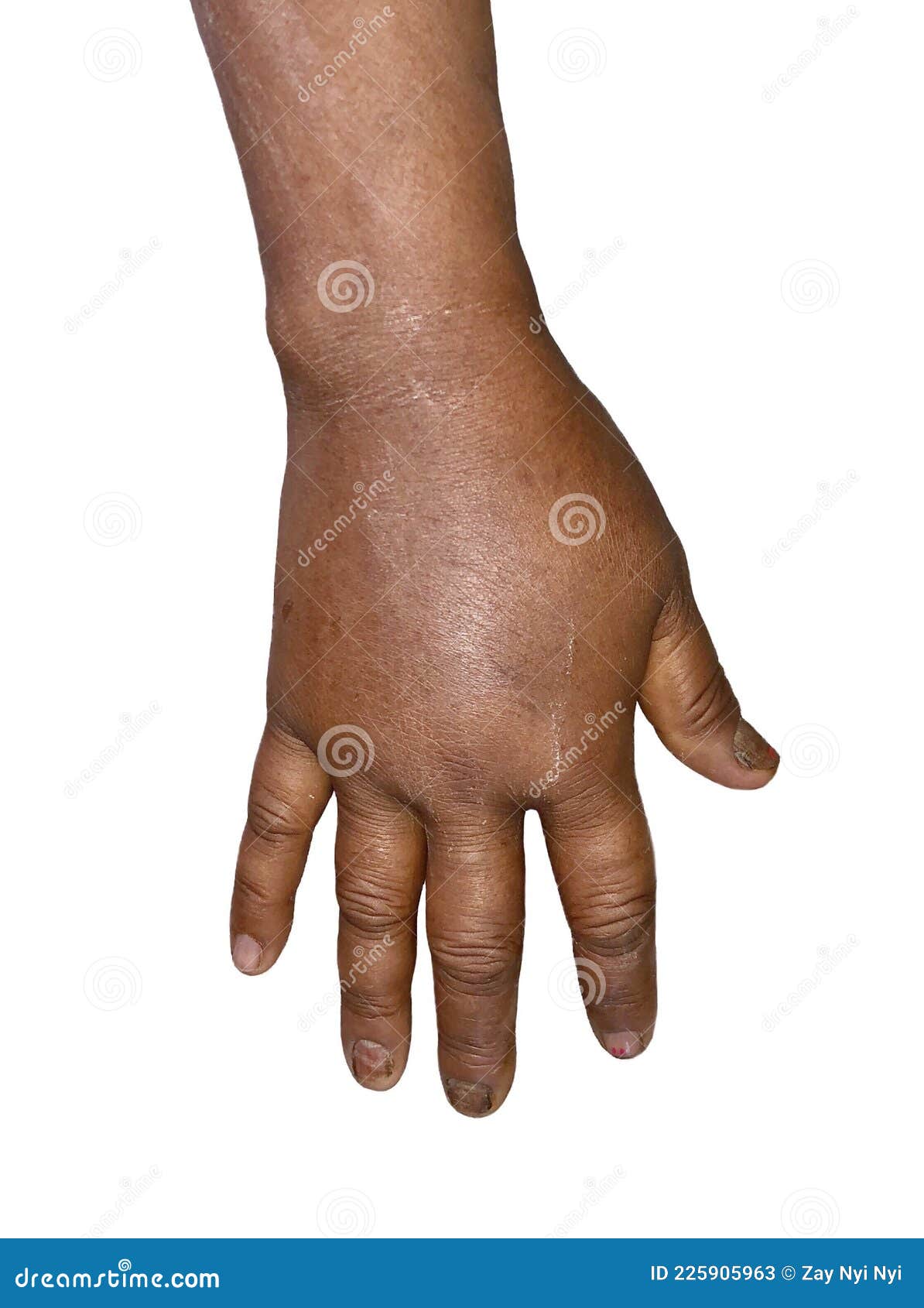 Unilateral Edema Of Upper Limb Swollen Hand And Arm Of Asian Woman