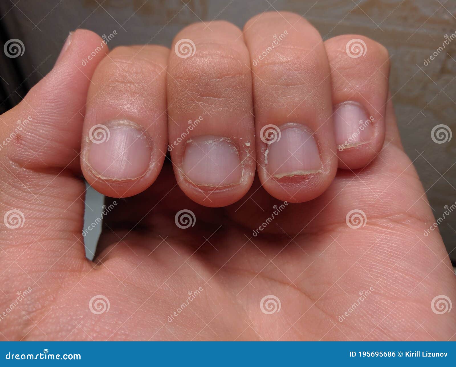 unkempt hand with fingers. fingers with cuticles and bad nails.