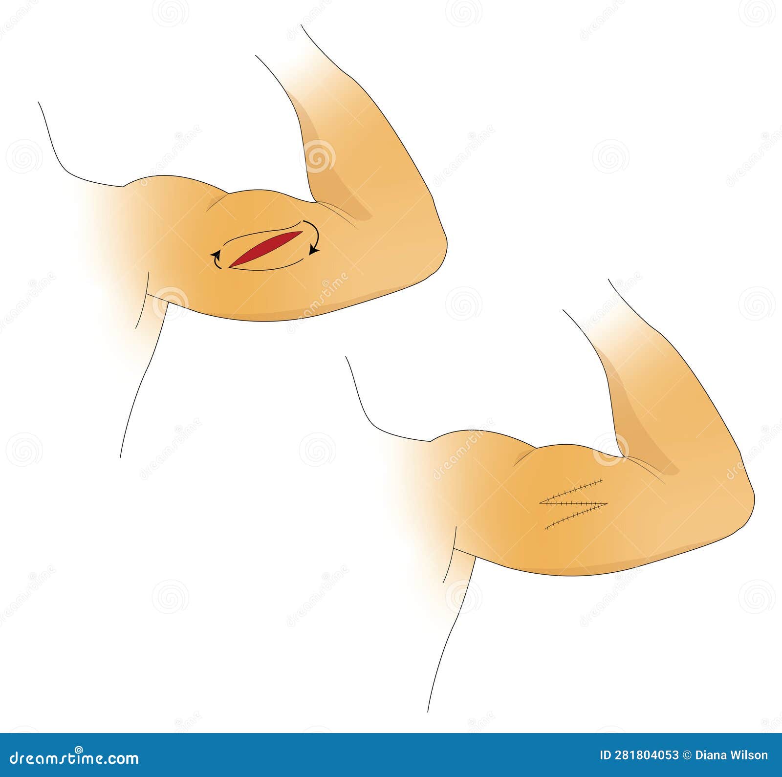 Adjacent Tissue Transfer or Rearrangement, Scalp, Arms and or Legs