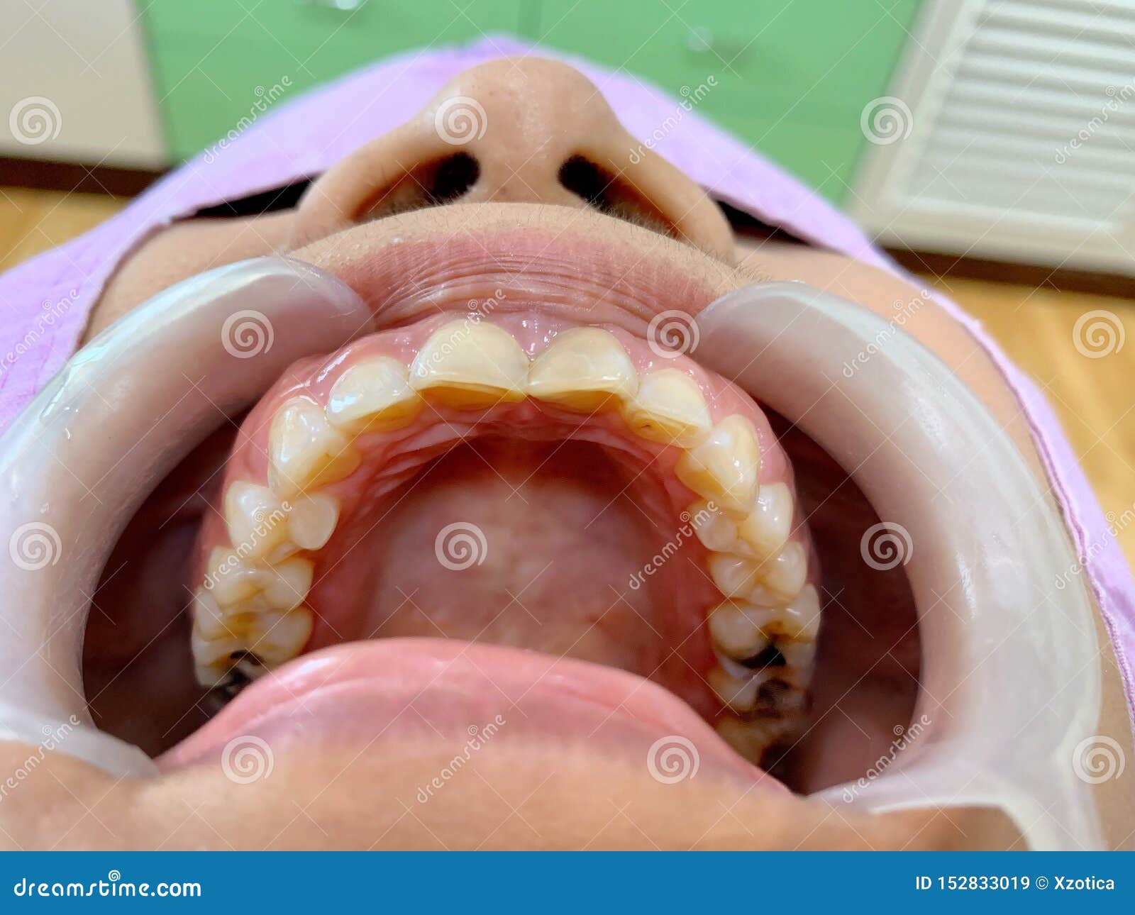 The Upper Teeth with Many Decayed Teeth and Mouth Gag Stock Image