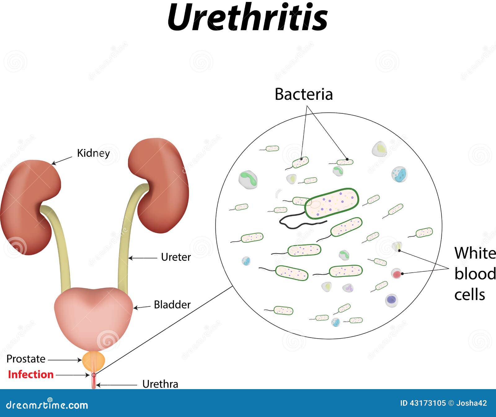 Urethritis, cystitis esetén alkalmazzák