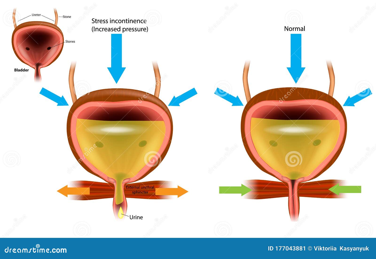 Urinary Incontinence UI, Also Known As Involuntary Stock Vector ...