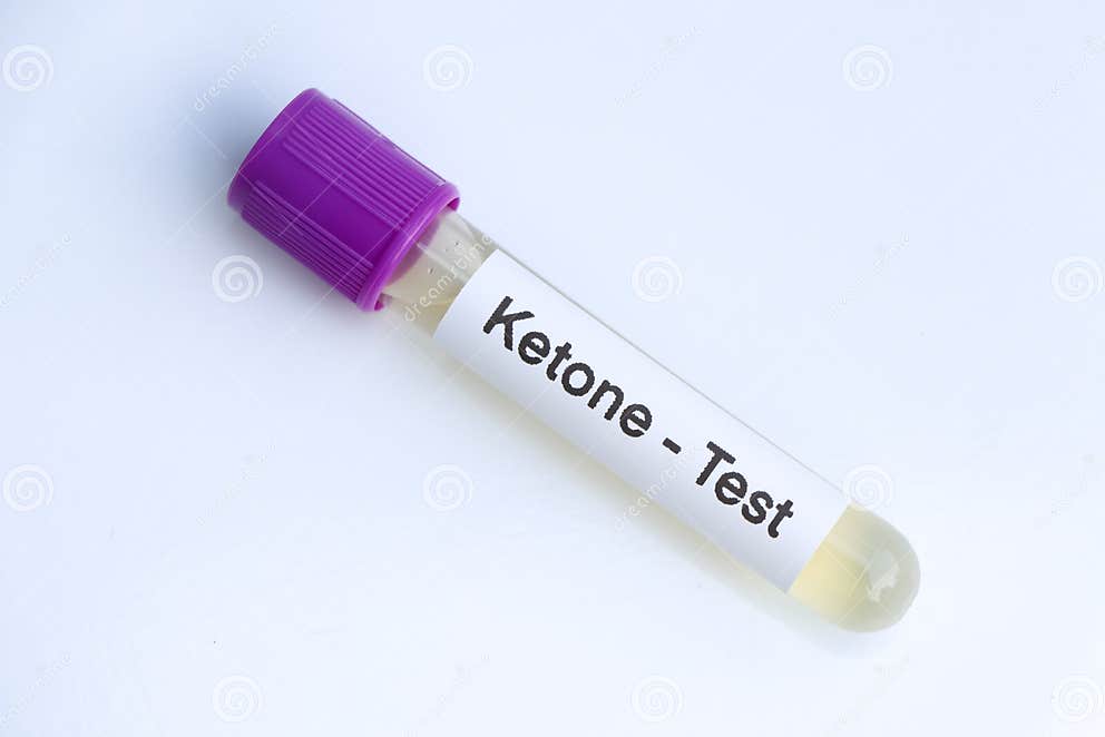 Urine Samples for Testing Ketones in the Laboratory Stock Image Image