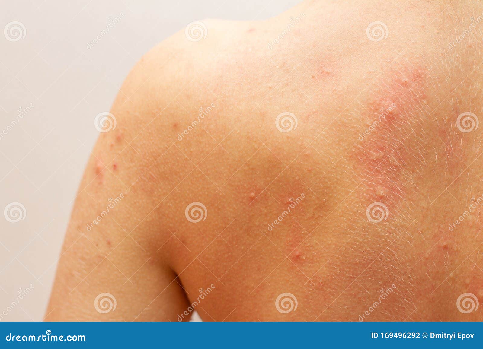 urticaria allergy on skin back, close up