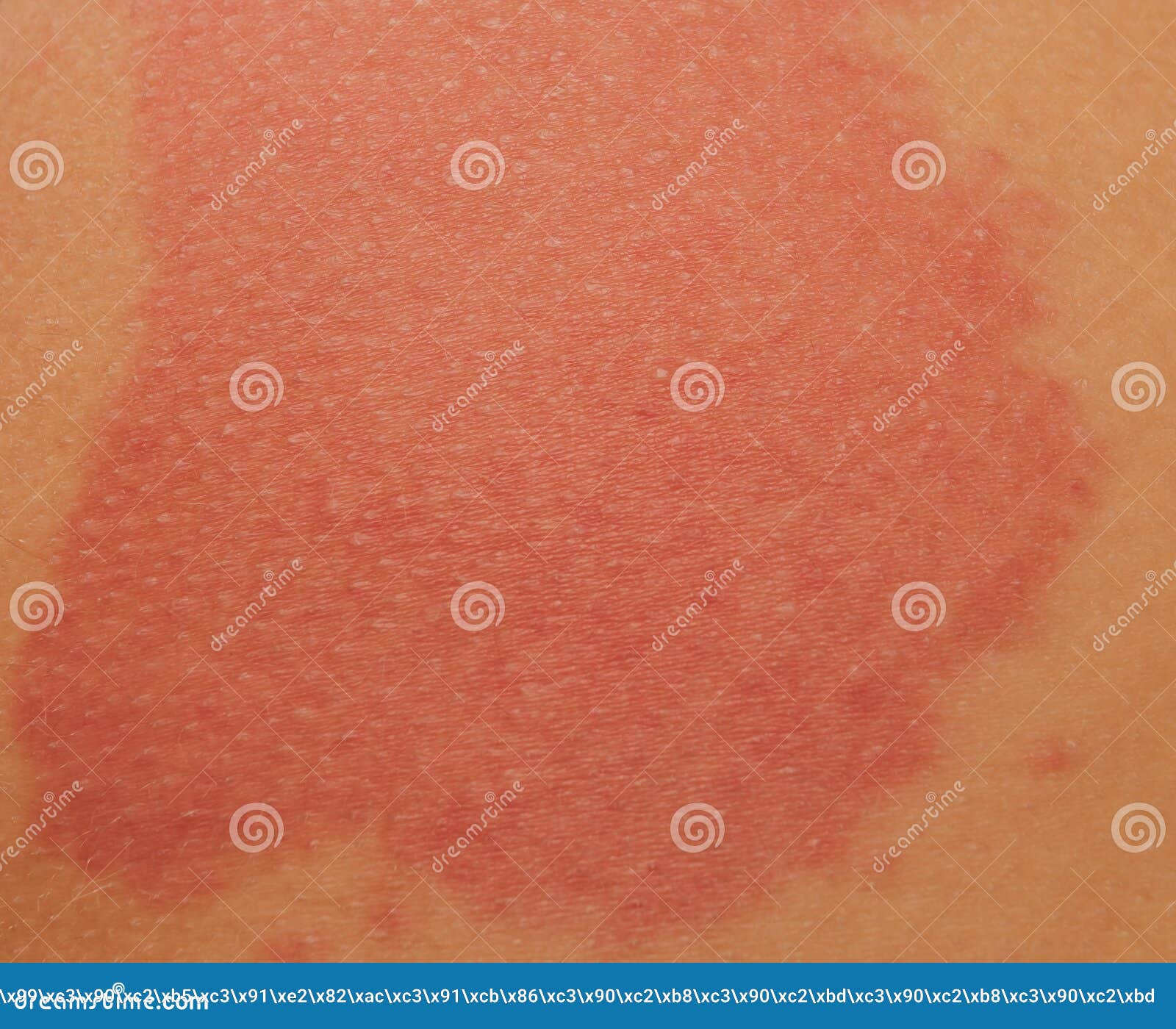 Urticaria Or Hives On The Back On The Shoulder Red Rashes Itchy Bumps