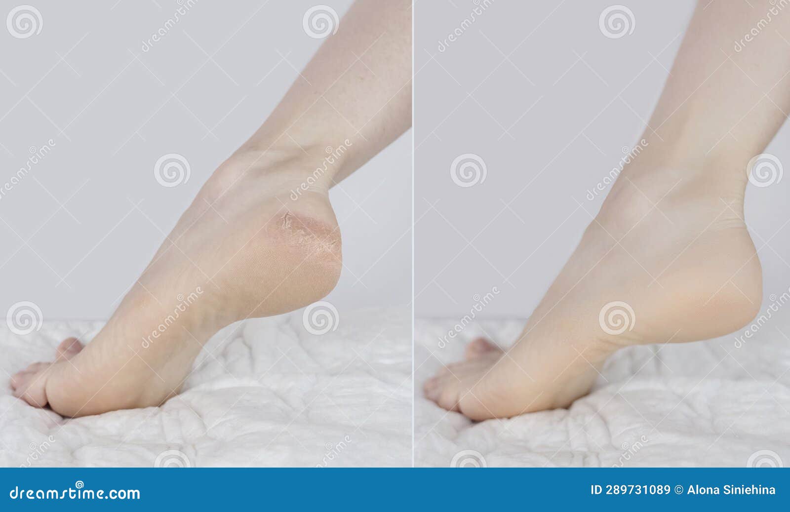 Cracked Heels. Woman Feet Before And After Procedures To Soften Rough Skin.  Urea Cream, Oil For Care Of Keratinized Skin, Healing Of Cracked Foot.  Usage Foot Grater, Cream With Urea, Softening Oil.