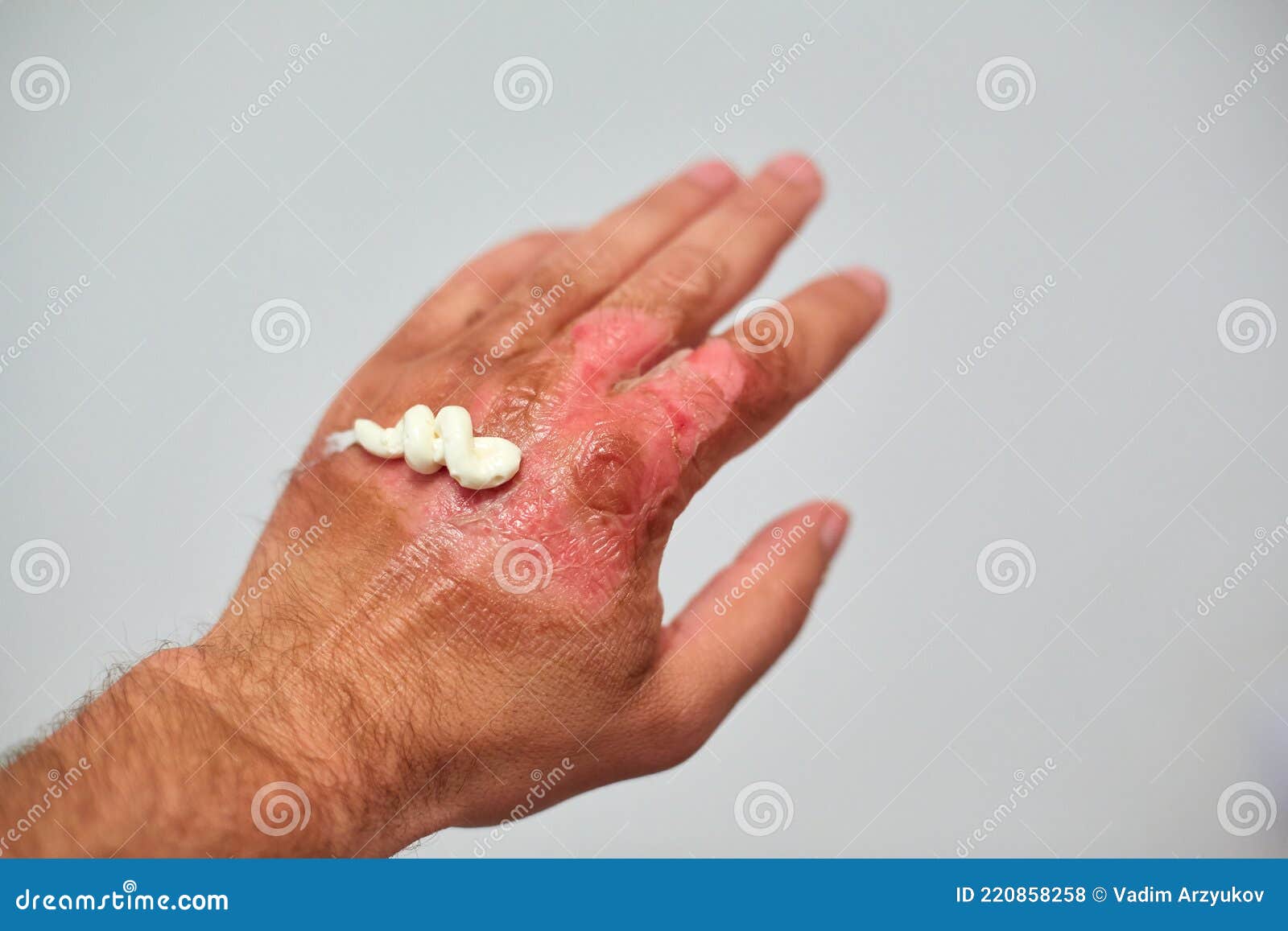 Use of Healing Ointment after Burns, First Aid for Body Burns Stock