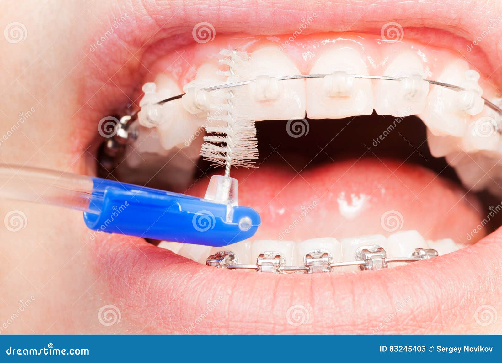 Using an Interdental Brush for Orthodontic Braces Stock Image Image