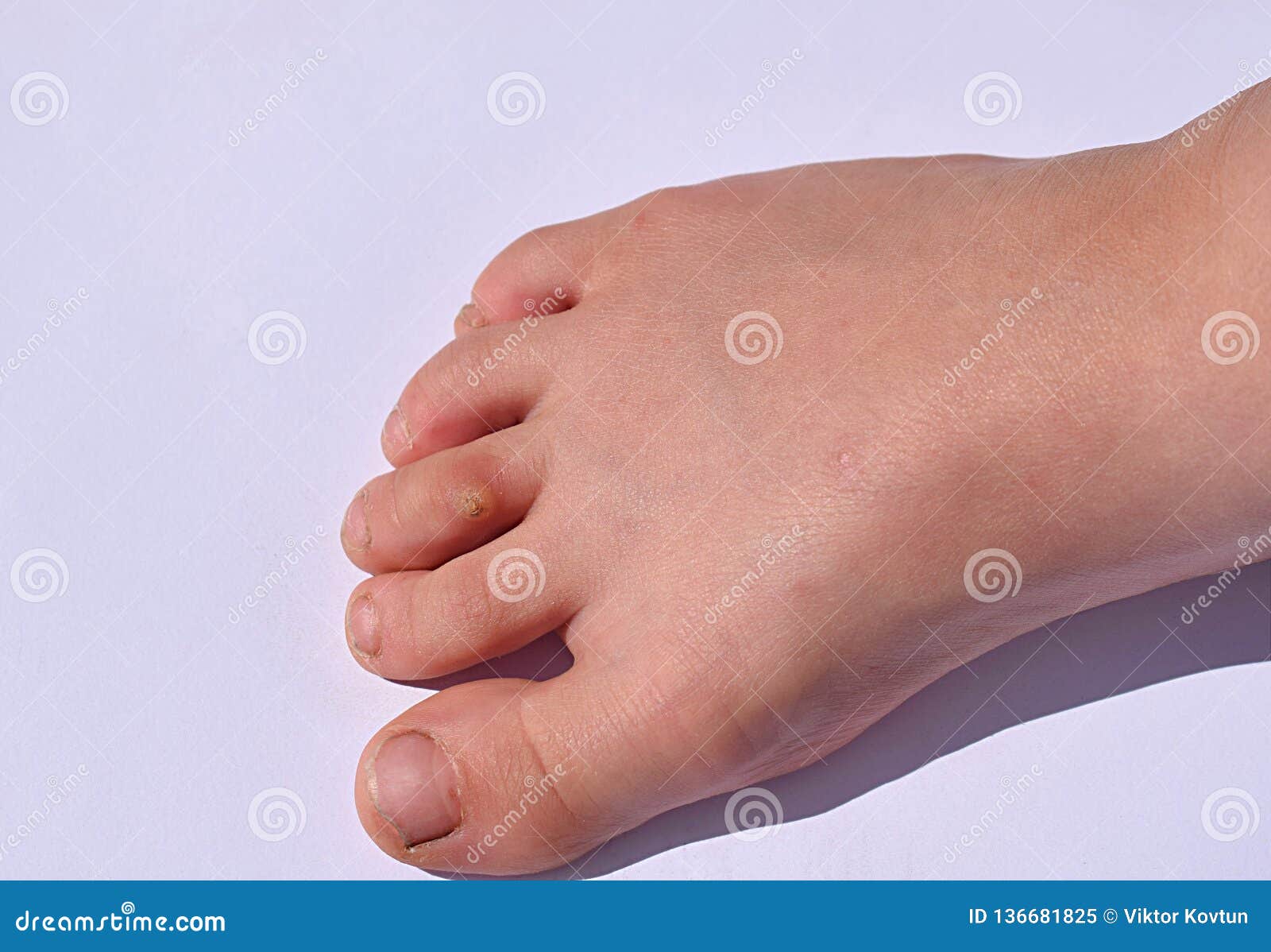 The Usual Flat Wart on the Child`s Toe Stock Image Image of verruca