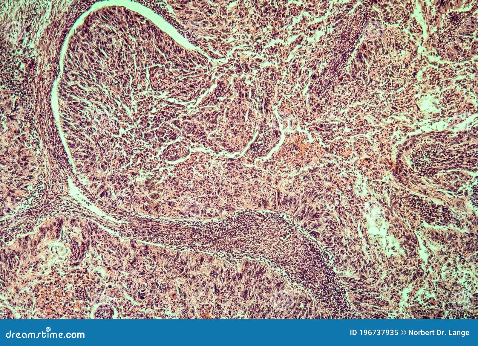 Uterine Cancer Diseased Tissue Stock Image - Image of histology ...