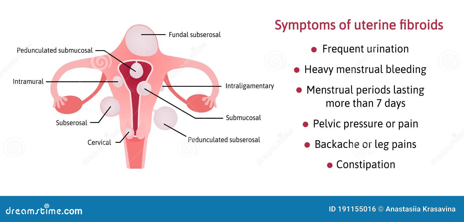 Submucosal Fibroids Endometriosis Infographics Vector Illustration submucosal-fibroids-endometriosis-infographics-vector-illustration