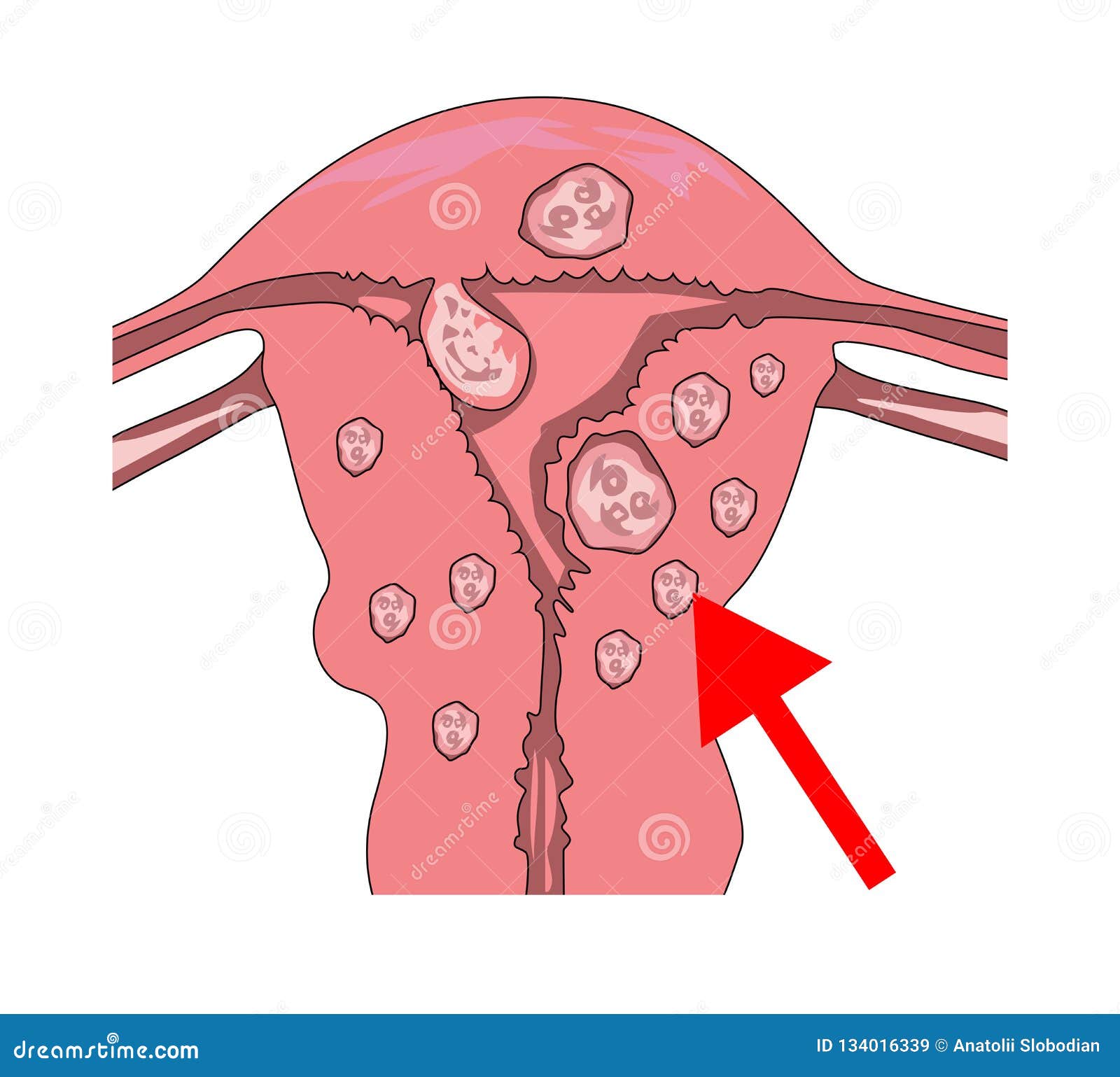 Myoma Of The Uterus Cartoon Vector CartoonDealer 74502819 myoma-of-the-uterus-cartoon-vector-cartoondealer-74502819