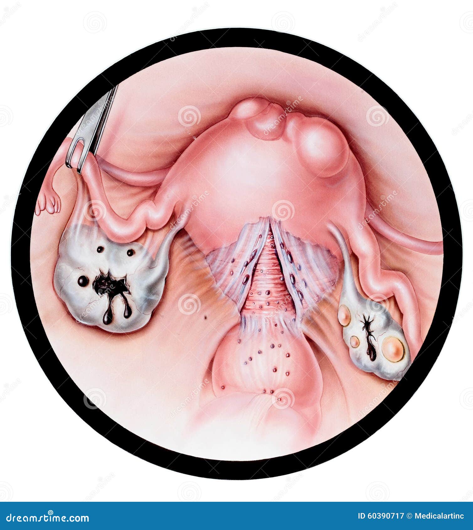 uterus - endometriosis