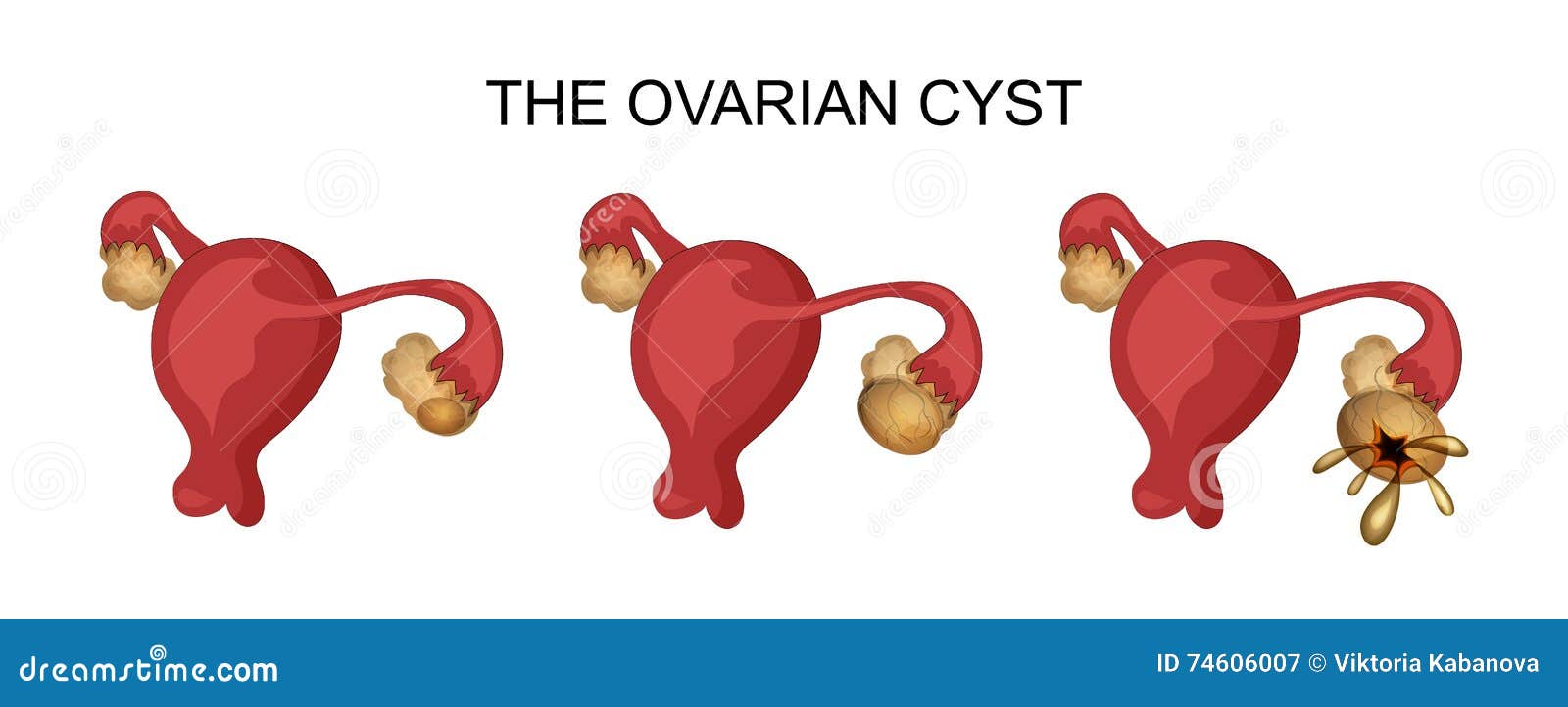 Uterus and ovarian cyst stock vector. Illustration of endometrium ...