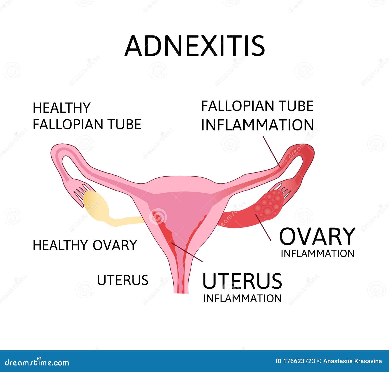 Adnexitis Anatomy