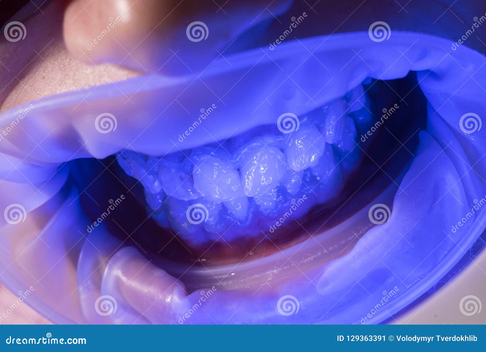 UV Whitening Teeth. Administer Anesthetics To Keep ...