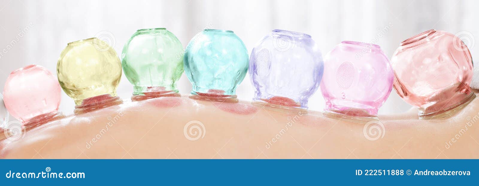 vacuum cupping therapy. close up detail of glass suction cups applied to patient`s back. web banner.