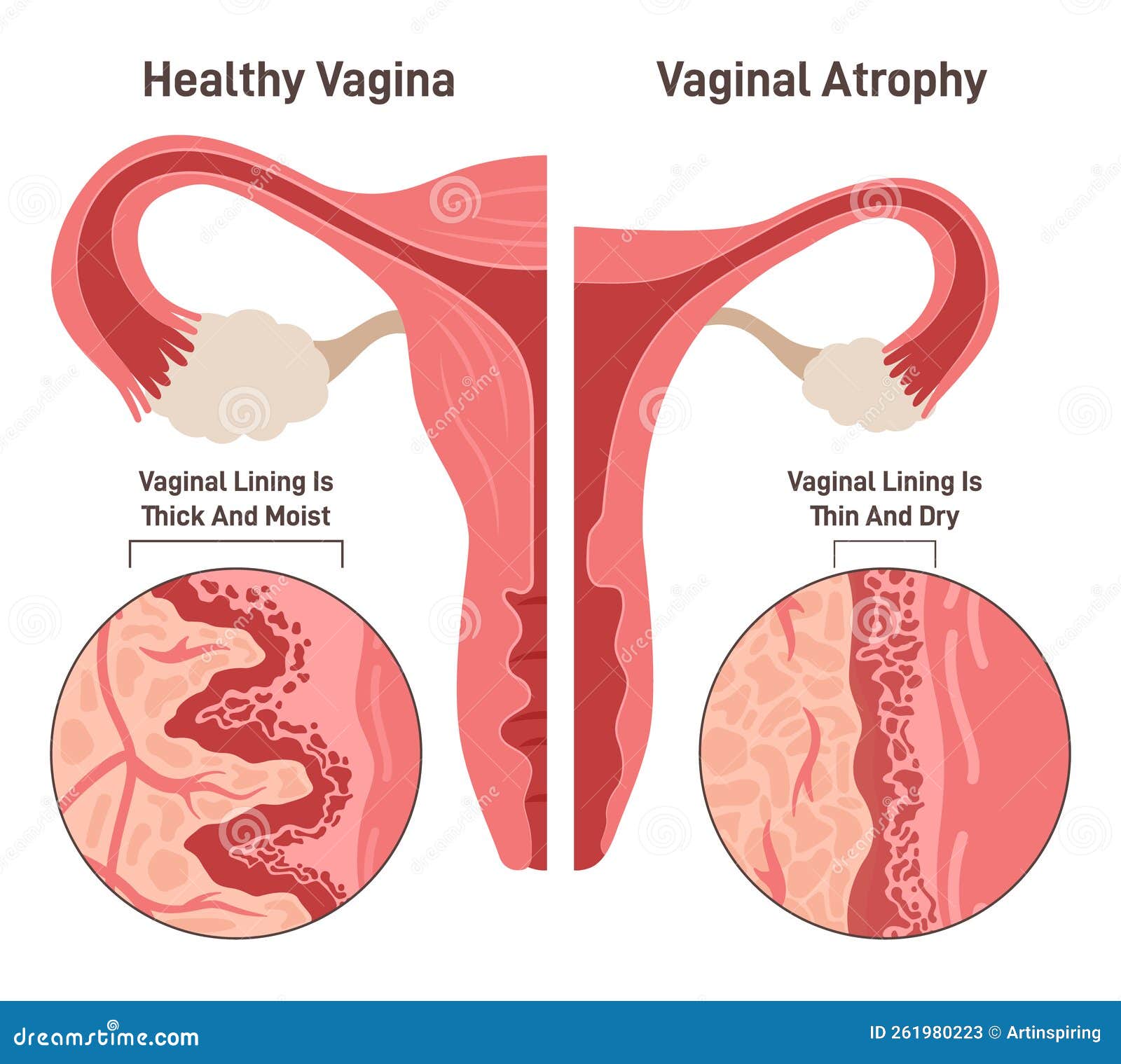 vaginal atrophy. thinning, drying and inflammation of the vaginal walls